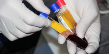 Benefits of using Dr. R. Akhmerov’s PRP tube: what are they need for