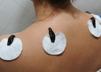 Пиявки для лечения: особенности и основные достоинства