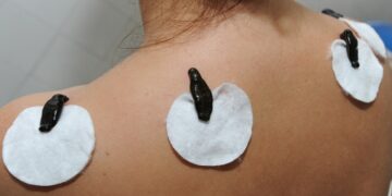 Пиявки для лечения: особенности и основные достоинства