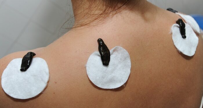 Пиявки для лечения: особенности и основные достоинства